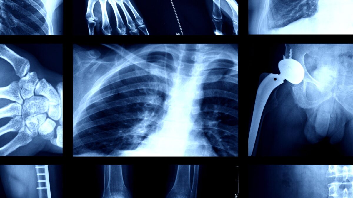 X-rays and Other Radiographic Tests for Cancer.