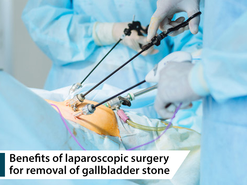 Benefits Of Laparoscopic Surgery For Removal Of Gallbladder Stone Atoallinks