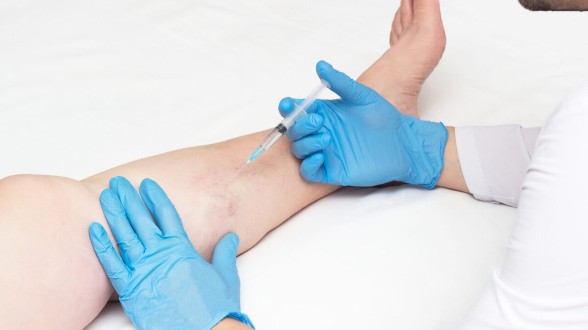 Can Compression Stockings Help With Varicose Veins?