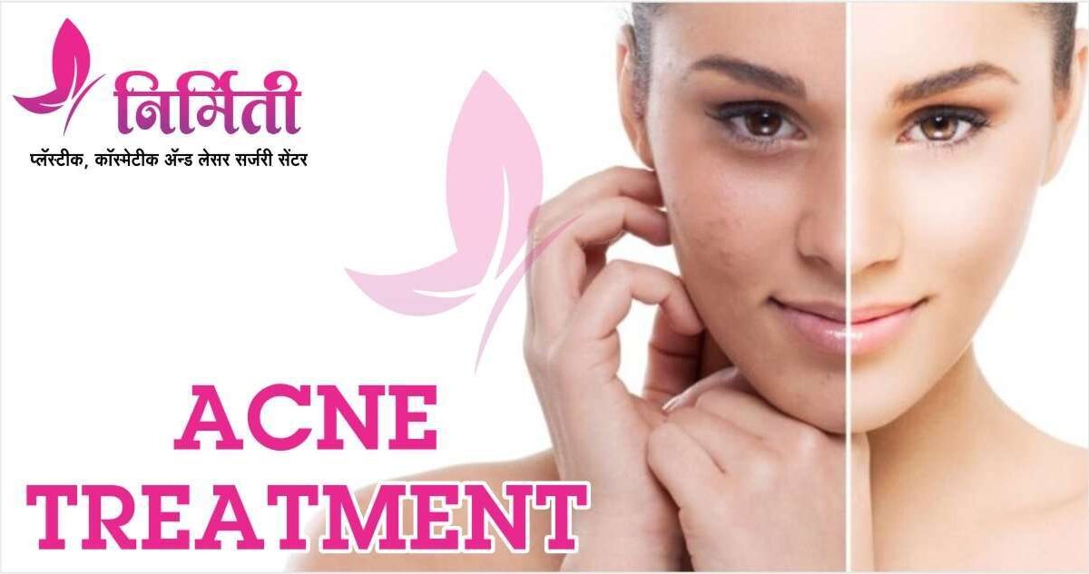 Revolutionize Your Routine with Our Acclaimed Acne Treatment!