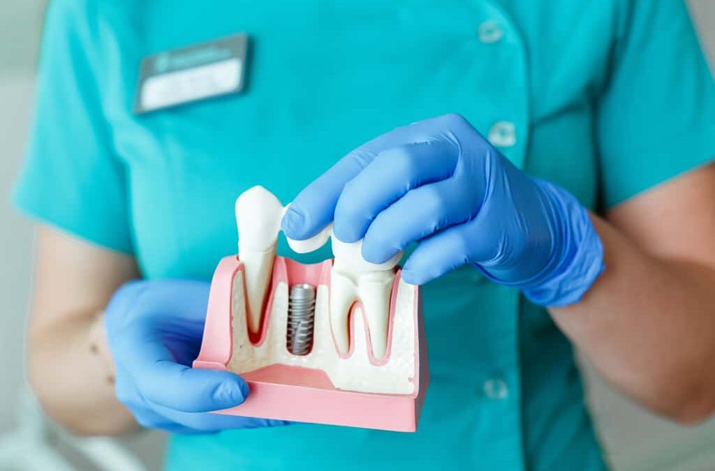 Top Implant Dentists in Houston: A Guide to Finding the Best Care