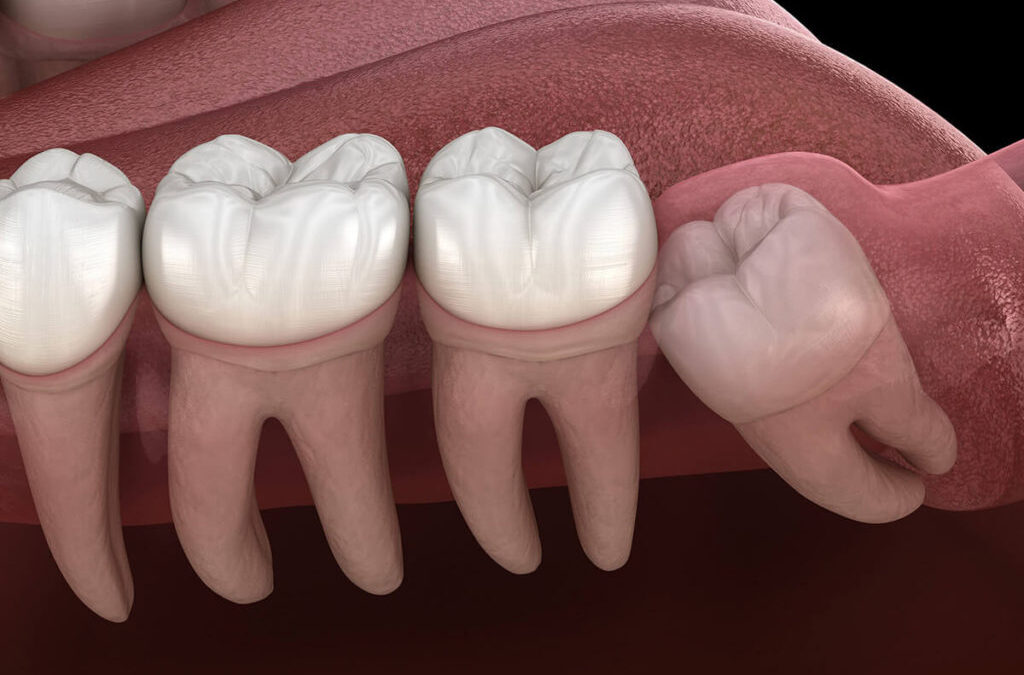 Expert Wisdom Teeth Removal in Charlotte NC: Your Guide to a Pain-Free Experience