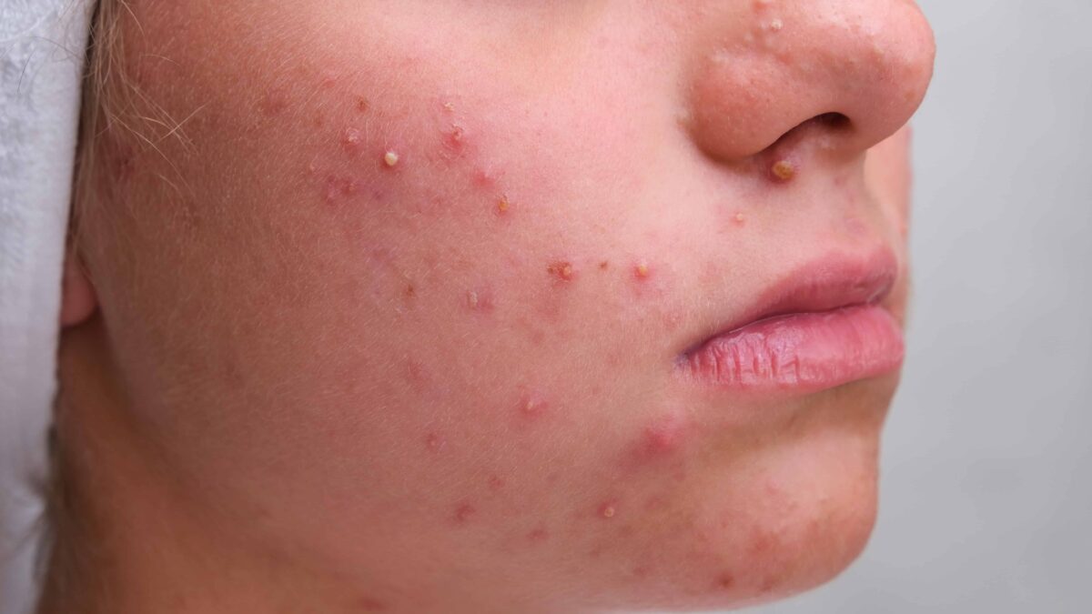 Practical Tips To Choose The Best Acne Scar Treatment In Delhi