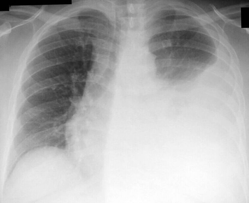 What are 4 complications of thoracentesis?