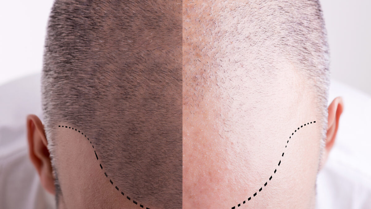 Scalp Micropigmentation: A Modern Solution for Hair Loss