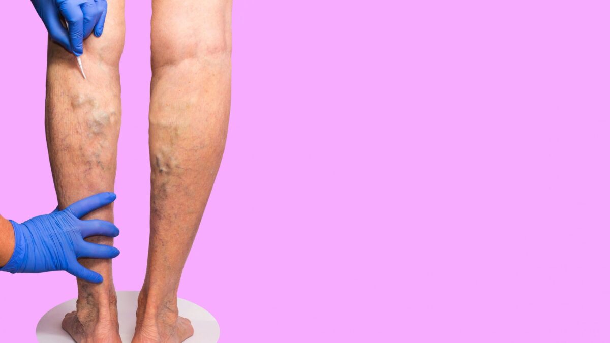 Choosing the Right Doctor for Varicose Vein Treatment
