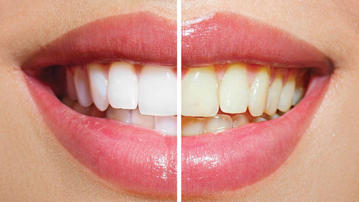 Achieving Whiter Teeth: Best Practices in Abu Dhabi