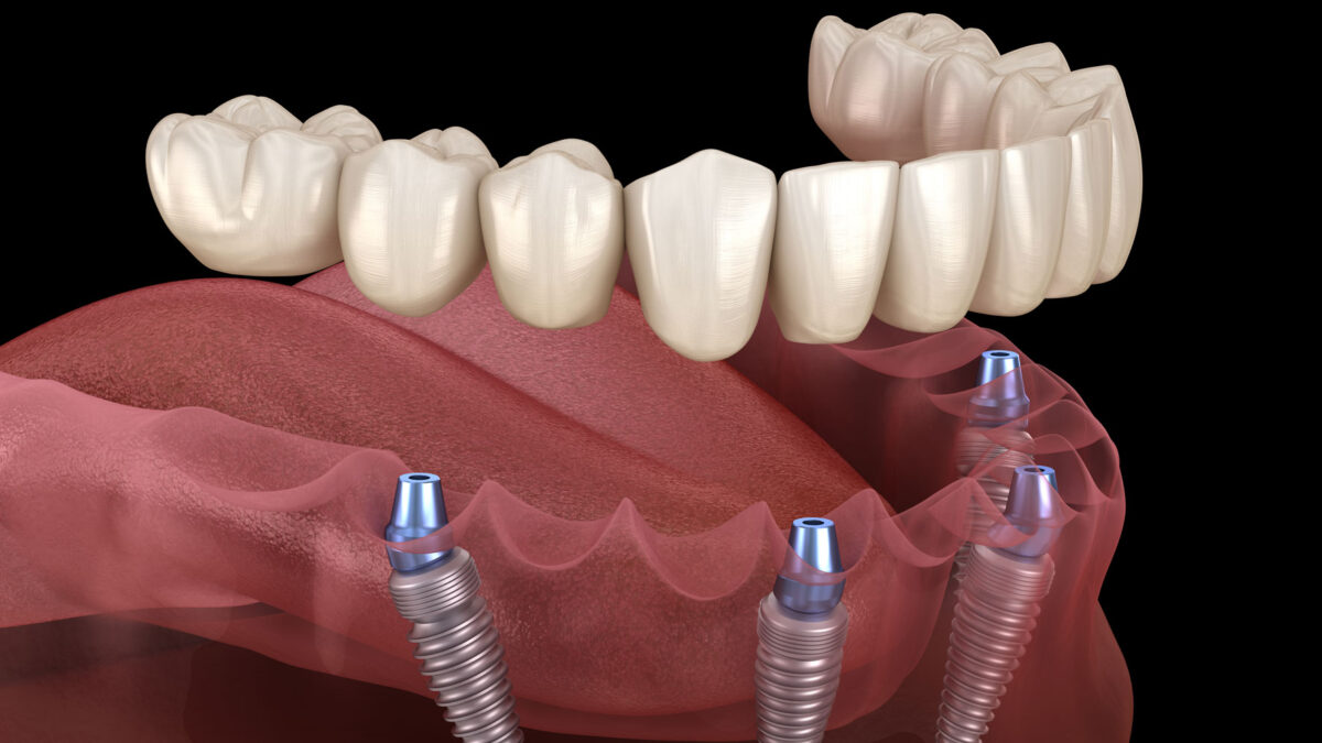 Are Full Mouth Dental Implants Worth the Investment?