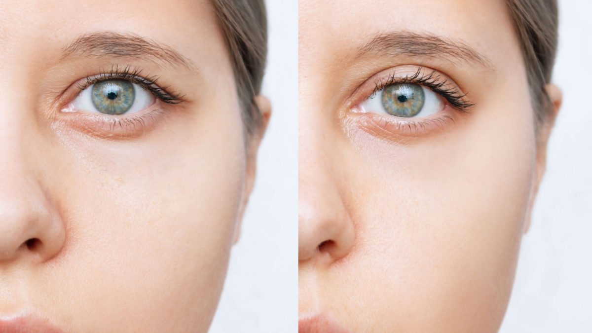 Unlock the Secret to Youthful Eyes with the Best Eyelid Surgeon in San Diego